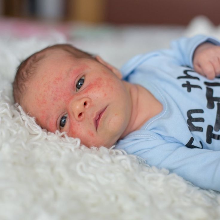 brotoeja em bebê fotos