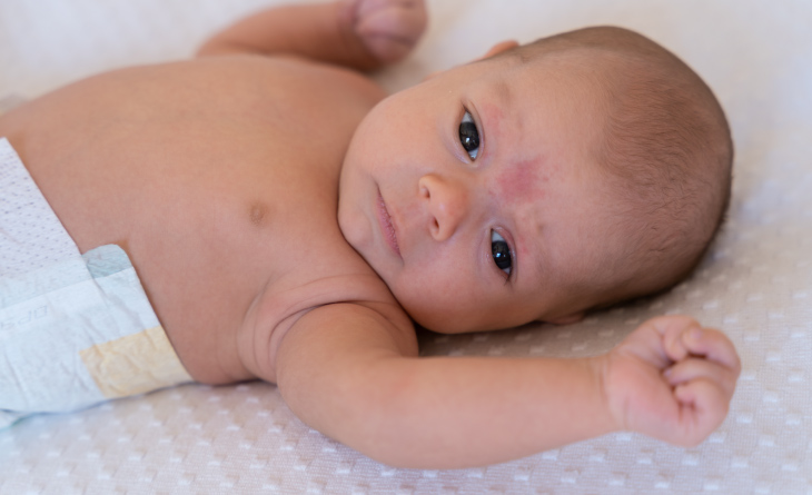 5 ideias de títulos:
1. Brotoeja em Bebês: Guia Completo para Identificação e Cuidados
2. Alívio Rápido: Como Tratar Brotoejas em Recém-Nascidos
3. Prevenindo Brotoejas: Dicas Essenciais para o Verão do seu Bebê
4. Brotoeja ou outra condição? Saiba diferenciar e agir
5. Remédios Caseiros e Médicos para Brotoejas em Bebês: O que Funciona?