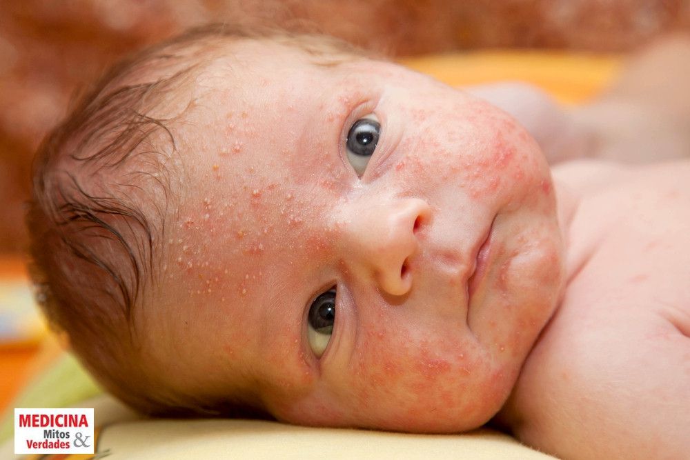 brotoeja em bebê fotos