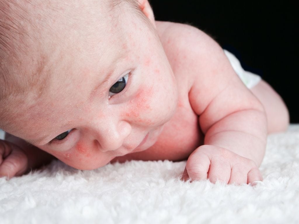 brotoeja em bebê fotos