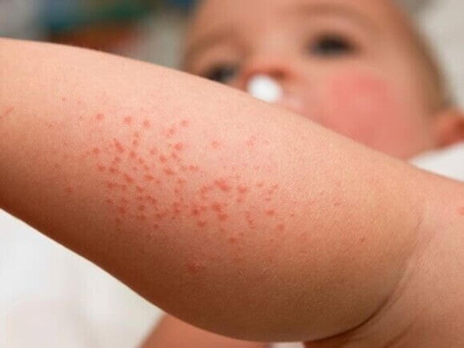 5 ideias de títulos:
1. Brotoeja em Bebês: Guia Completo para Identificação e Cuidados
2. Alívio Rápido: Como Tratar Brotoejas em Recém-Nascidos
3. Prevenindo Brotoejas: Dicas Essenciais para o Verão do seu Bebê
4. Brotoeja ou outra condição? Saiba diferenciar e agir
5. Remédios Caseiros e Médicos para Brotoejas em Bebês: O que Funciona?