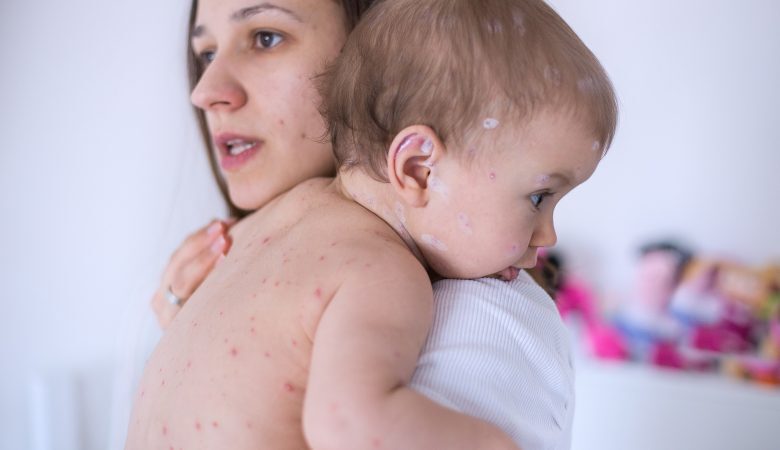 5 ideias de títulos:
1. Brotoeja em Bebês: Guia Completo para Identificação e Cuidados
2. Alívio Rápido: Como Tratar Brotoejas em Recém-Nascidos
3. Prevenindo Brotoejas: Dicas Essenciais para o Verão do seu Bebê
4. Brotoeja ou outra condição? Saiba diferenciar e agir
5. Remédios Caseiros e Médicos para Brotoejas em Bebês: O que Funciona?