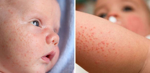 brotoeja em bebê fotos