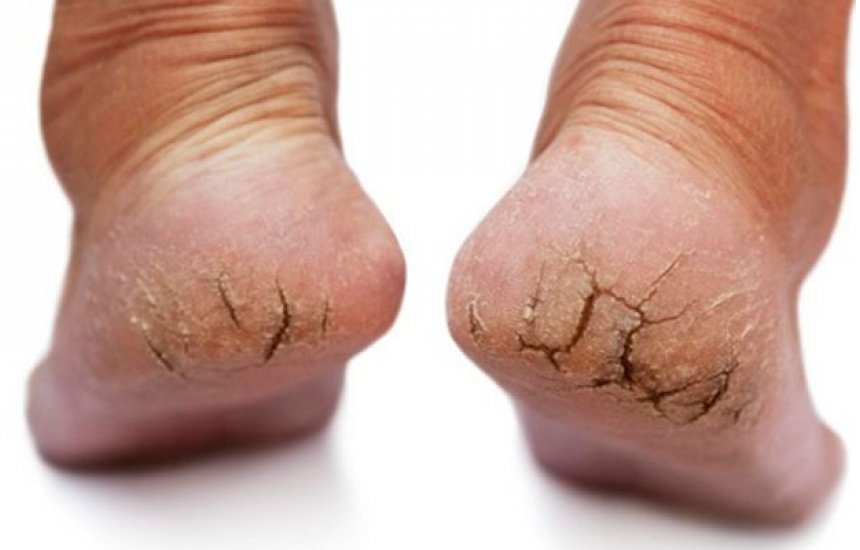 calcanhares rachados