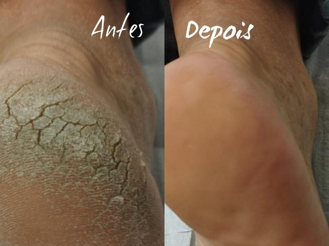 Guia Completo: Como Escolher o Creme de Ureia Ideal para Seus Pés Rachados