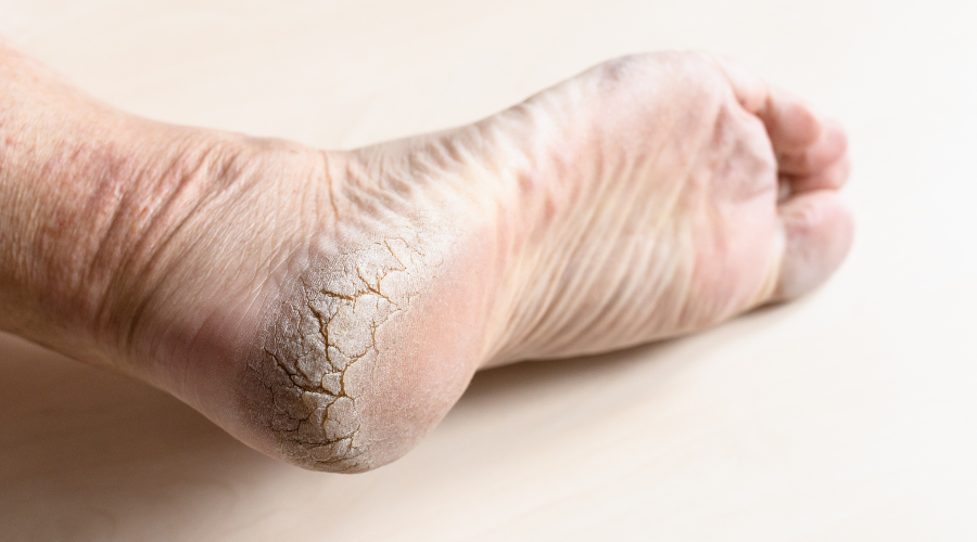 Tratamentos Caseiros Eficazes para Calcanhares Rachados: Receitas e Dicas