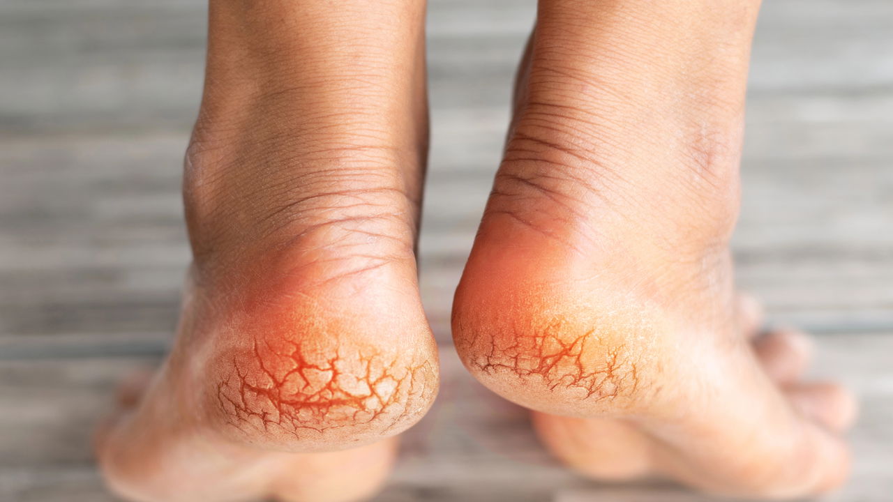 Pés Rachados e Diabetes: Entenda a Conexão e Saiba Como Prevenir Complicações