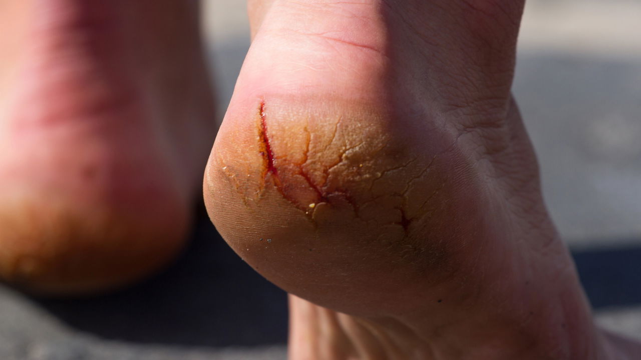 Mitos e Verdades sobre Lixar os Pés: O Que Você Precisa Saber para Evitar o Efeito Rebote