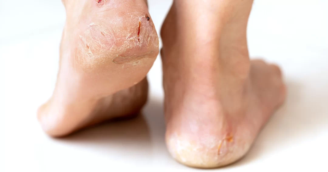 Tratamentos Caseiros Eficazes para Calcanhares Rachados: Receitas e Dicas