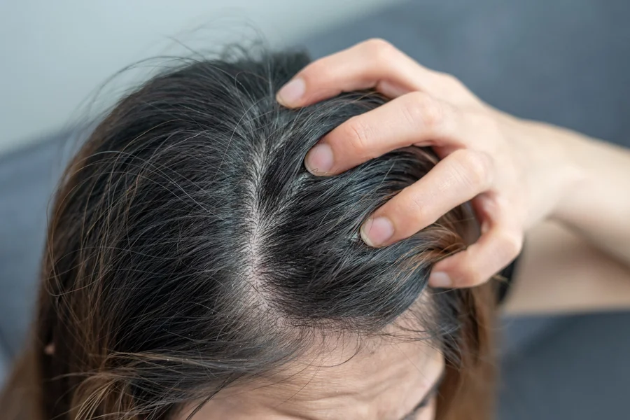 Dermatite Seborreica: Entenda a Relação com a Perda Capilar