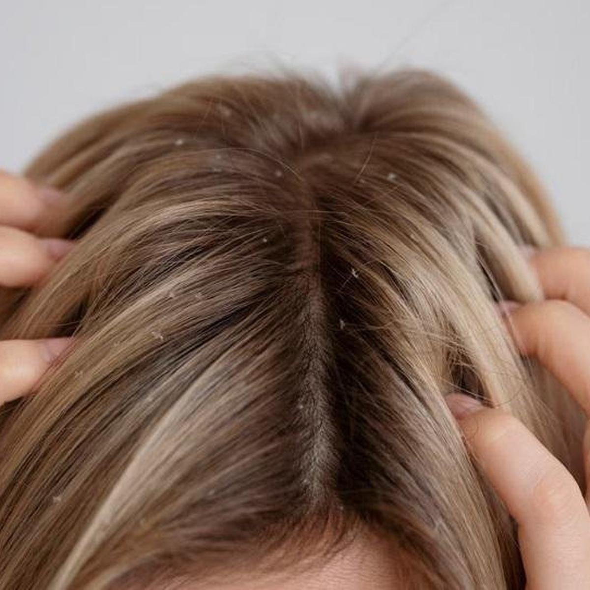 Os Mitos e Verdades Sobre Caspa e a Saúde dos Seus Fios