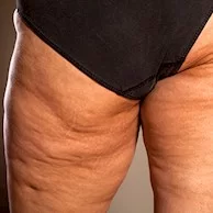 Guia Completo de Procedimentos Estéticos para Celulite: Radiofrequência