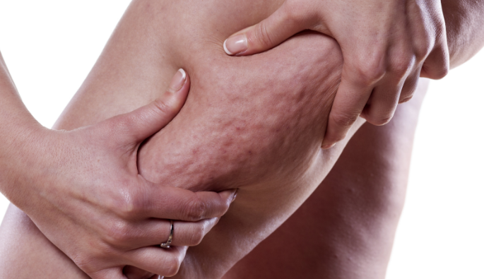 Exercícios para Reduzir Celulite: Agachamentos e Atividades para Firmar a Pele