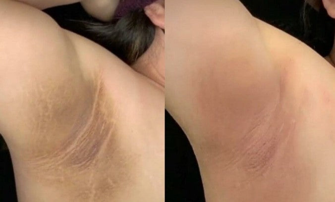 Guia Completo: Como Escolher o Melhor Creme Clareador de Axilas na Farmácia