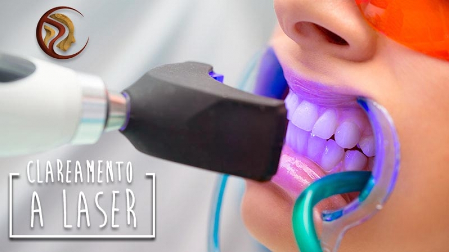 Clareamento Dental a Laser: Mitos, Verdades e Como Funciona