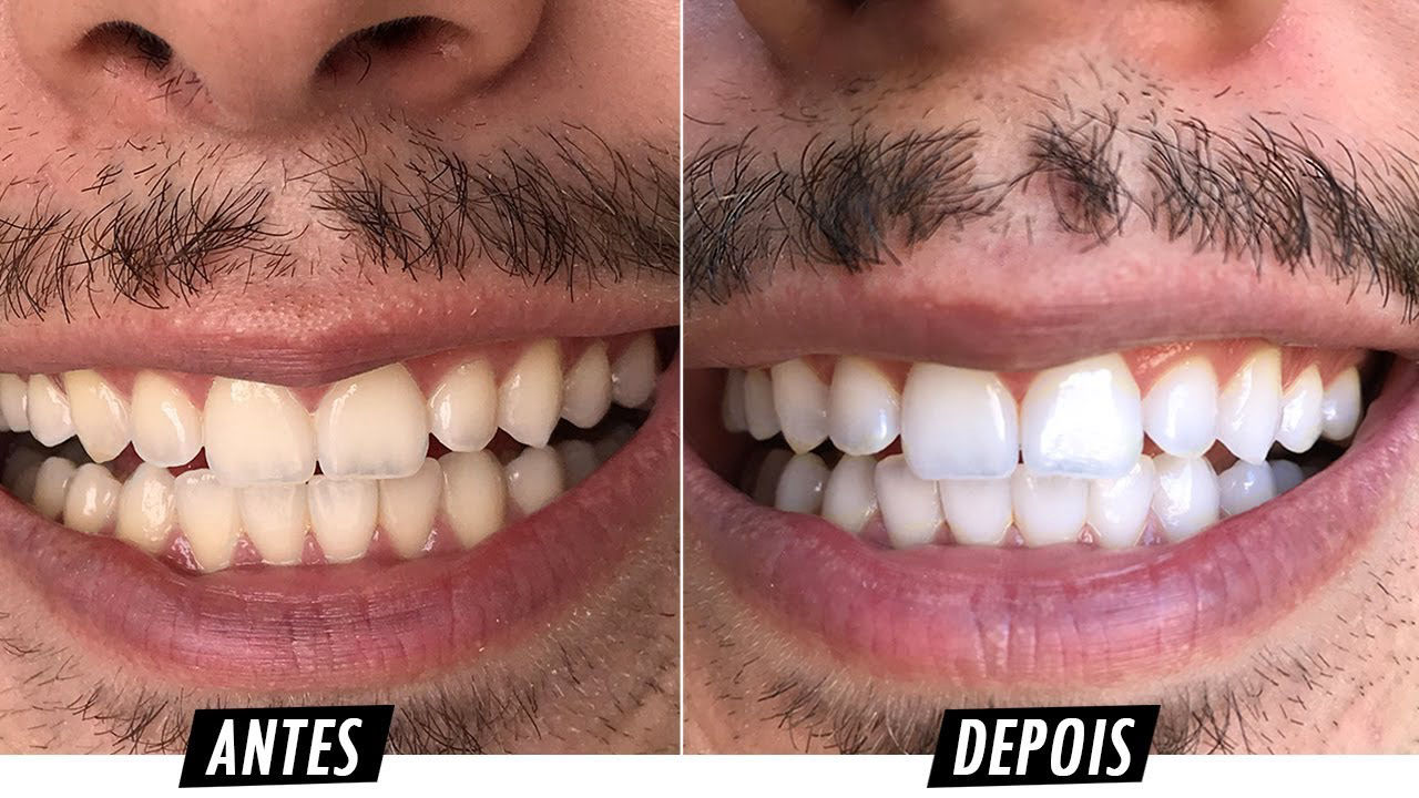 Sensibilidade Após Clareamento Dental a Laser: Dicas para Aliviar