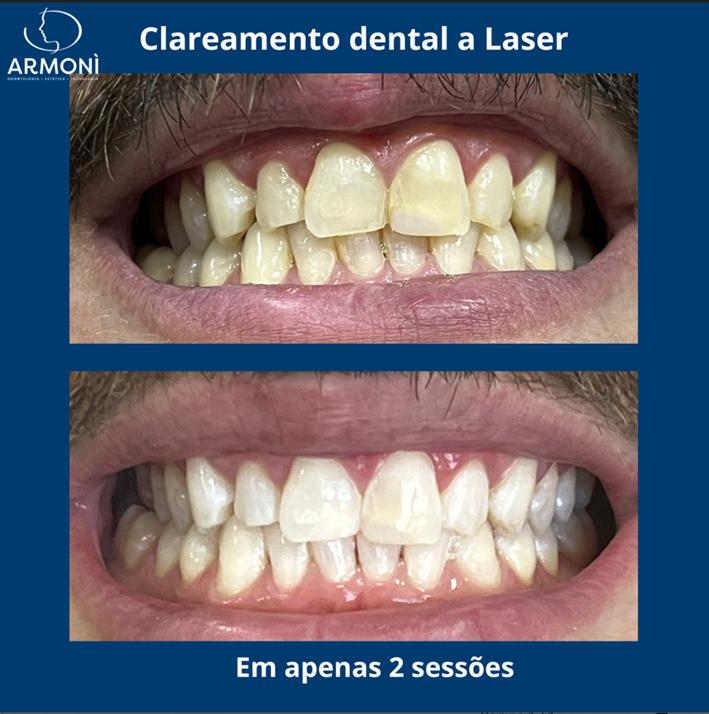 Maximize seus Resultados: O Guia Definitivo do Clareamento Conjugado