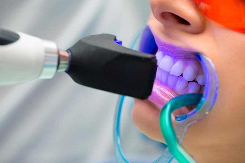 Quanto Custa o Clareamento Dental a Laser? Um Guia Completo