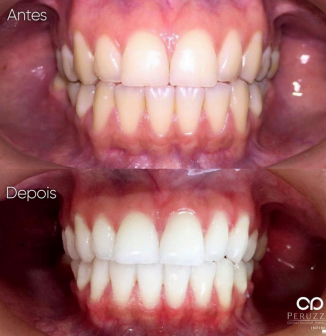 Clareamento a Laser vs. Clareamento Caseiro: Qual o Melhor para Você?