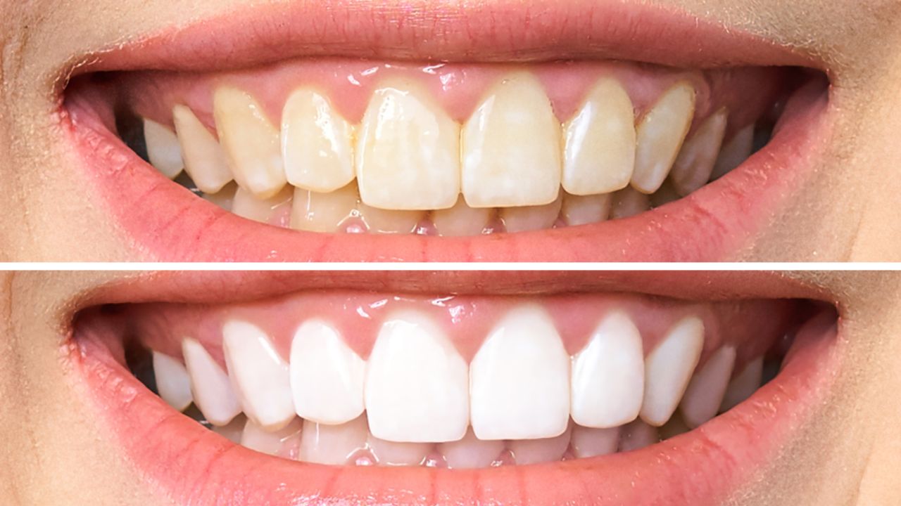 Clareamento a Laser vs. Clareamento Caseiro: Qual o Melhor para Você?