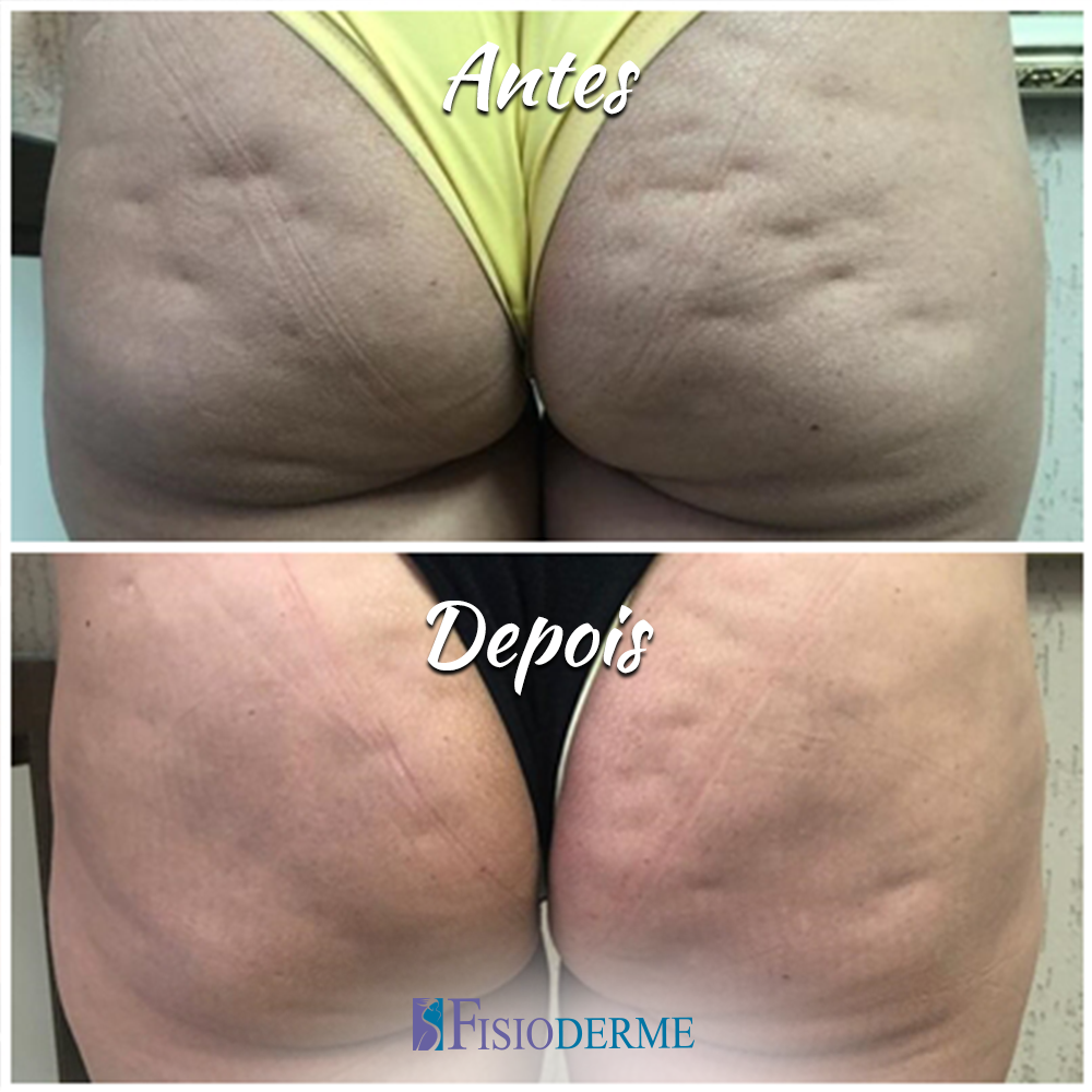 Alimentação e Exercícios: Seus Aliados Contra a Celulite