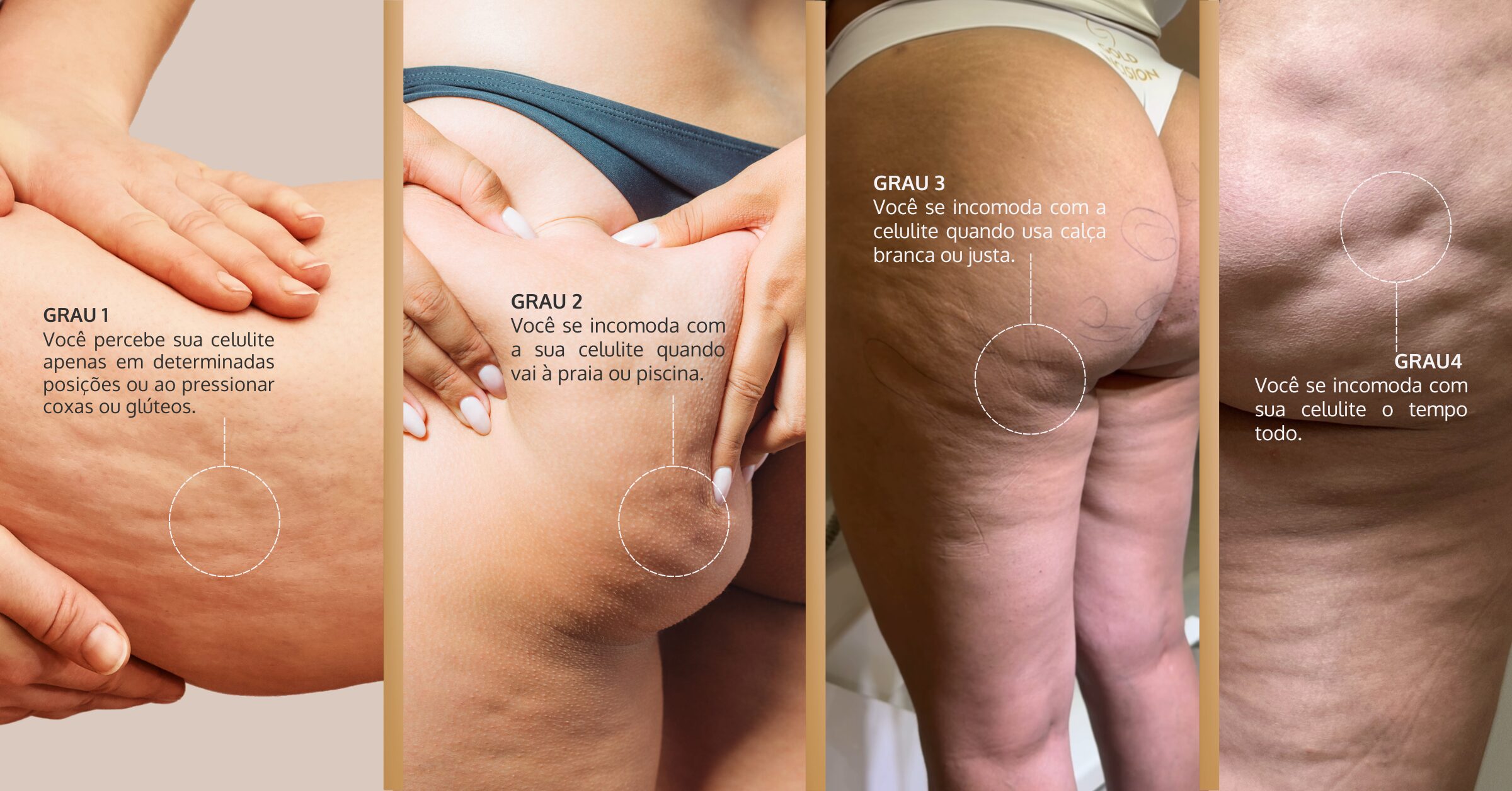 Celulite Infecciosa vs. Estética: Saiba a Diferença e Quando Procurar um Médico