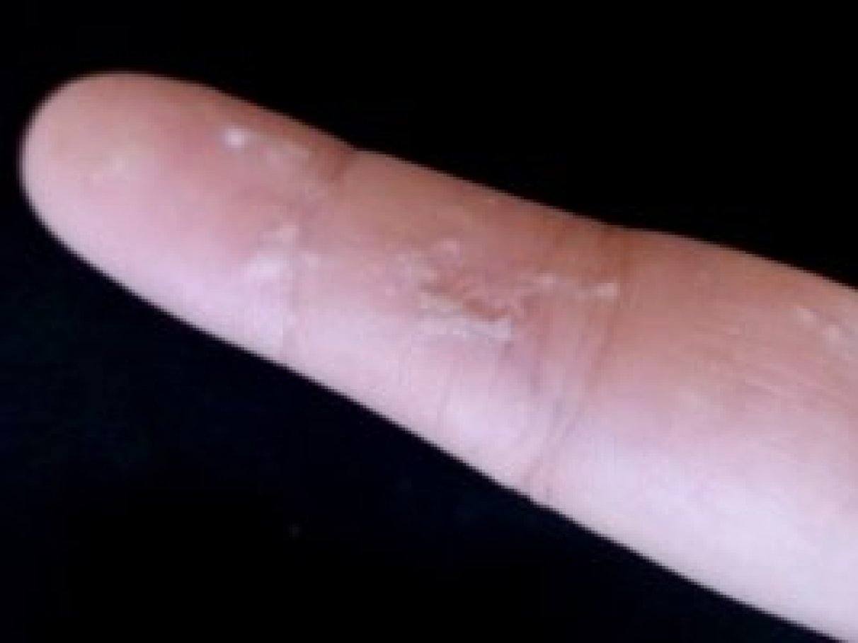 corrimento pastoso branco