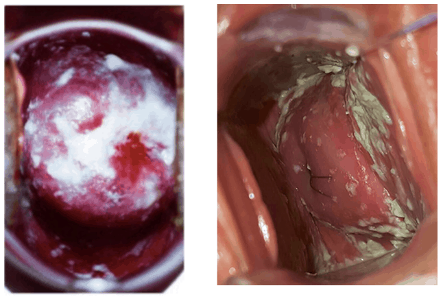Como identificar os diferentes tipos de corrimento vaginal?