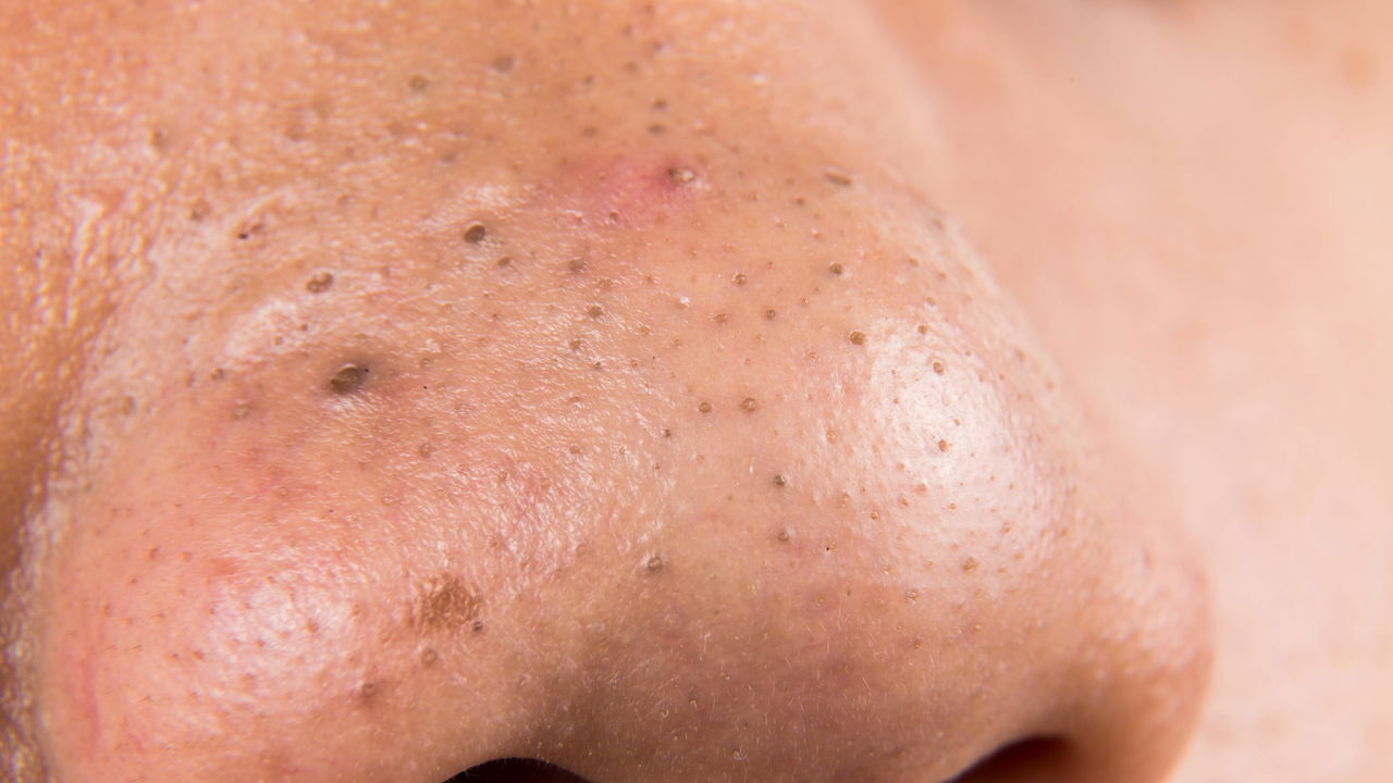 como tirar cravos do nariz