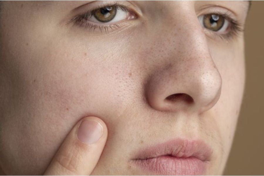 tratamento para cravos