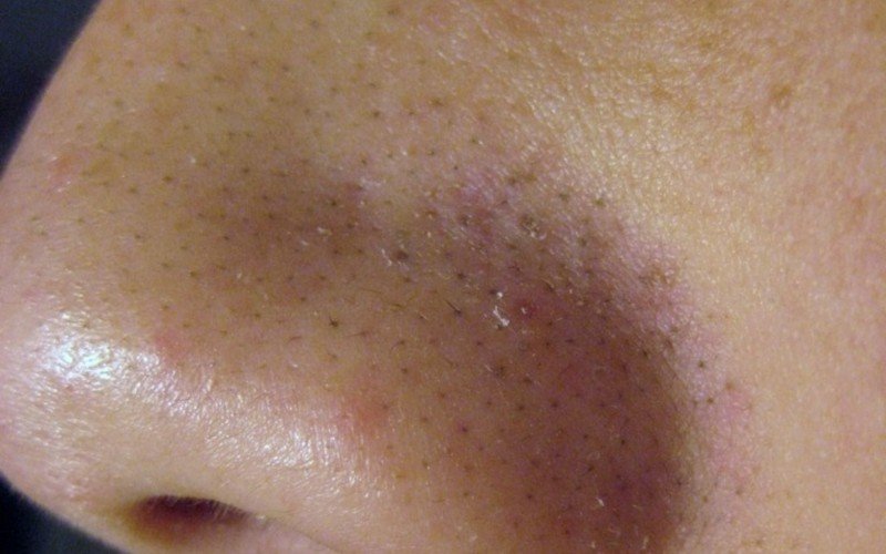 como tirar cravos do nariz