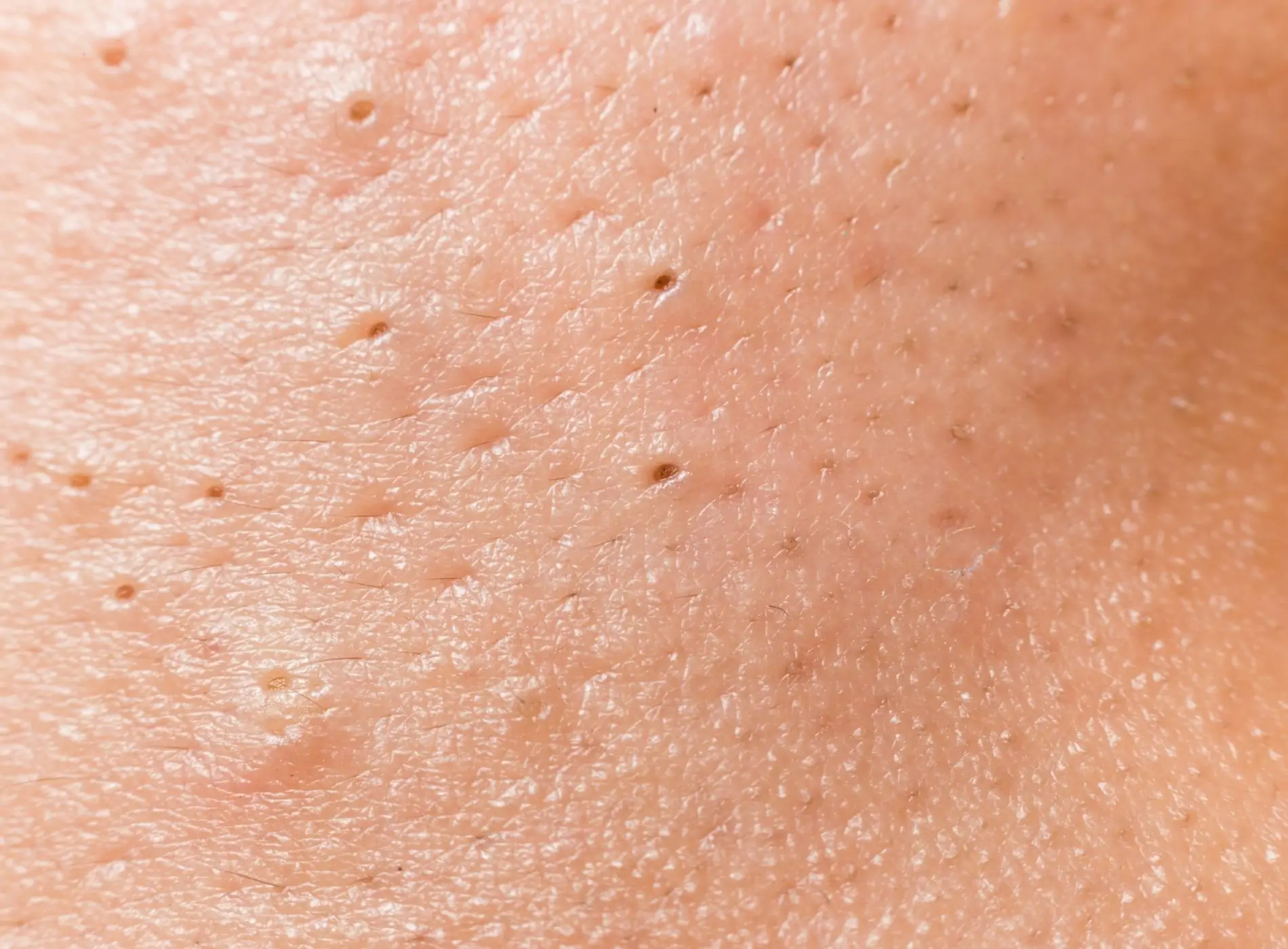 ácido salicílico para cravos