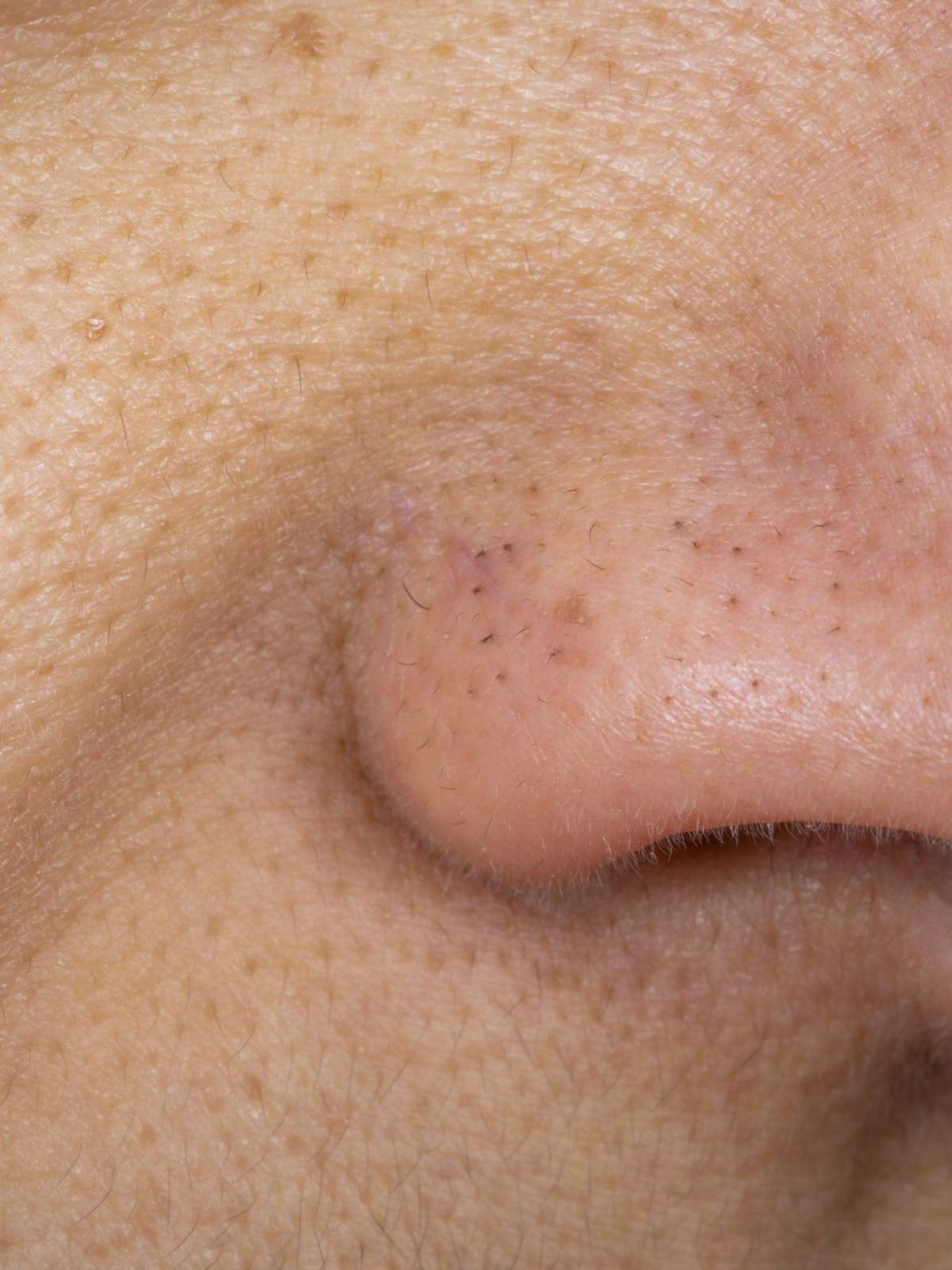 ácido salicílico para cravos