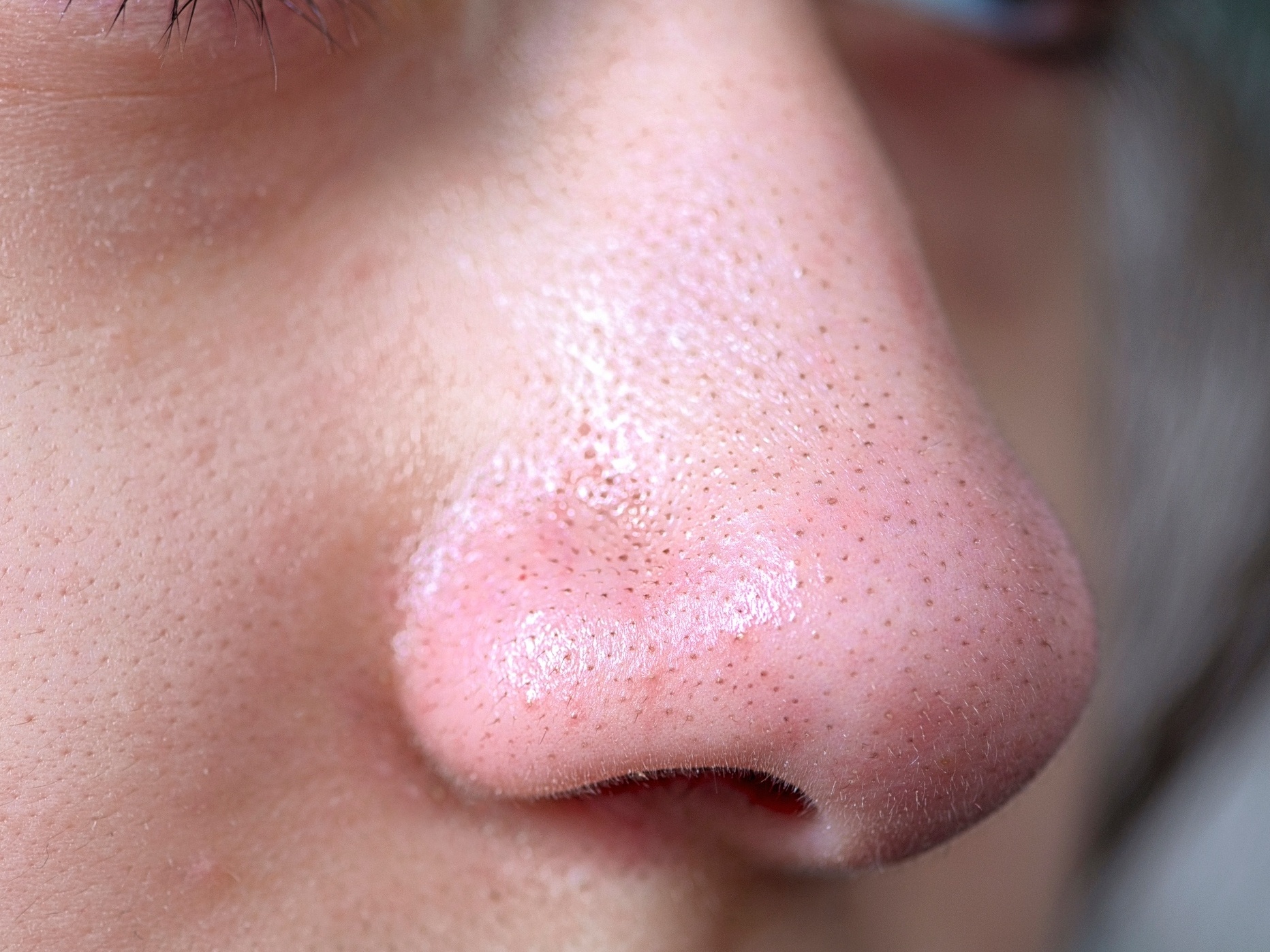 ácido salicílico para cravos