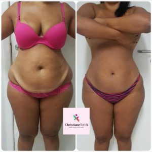 Cuidados Pós-Criomodelagem: Dicas para Potencializar Seus Resultados