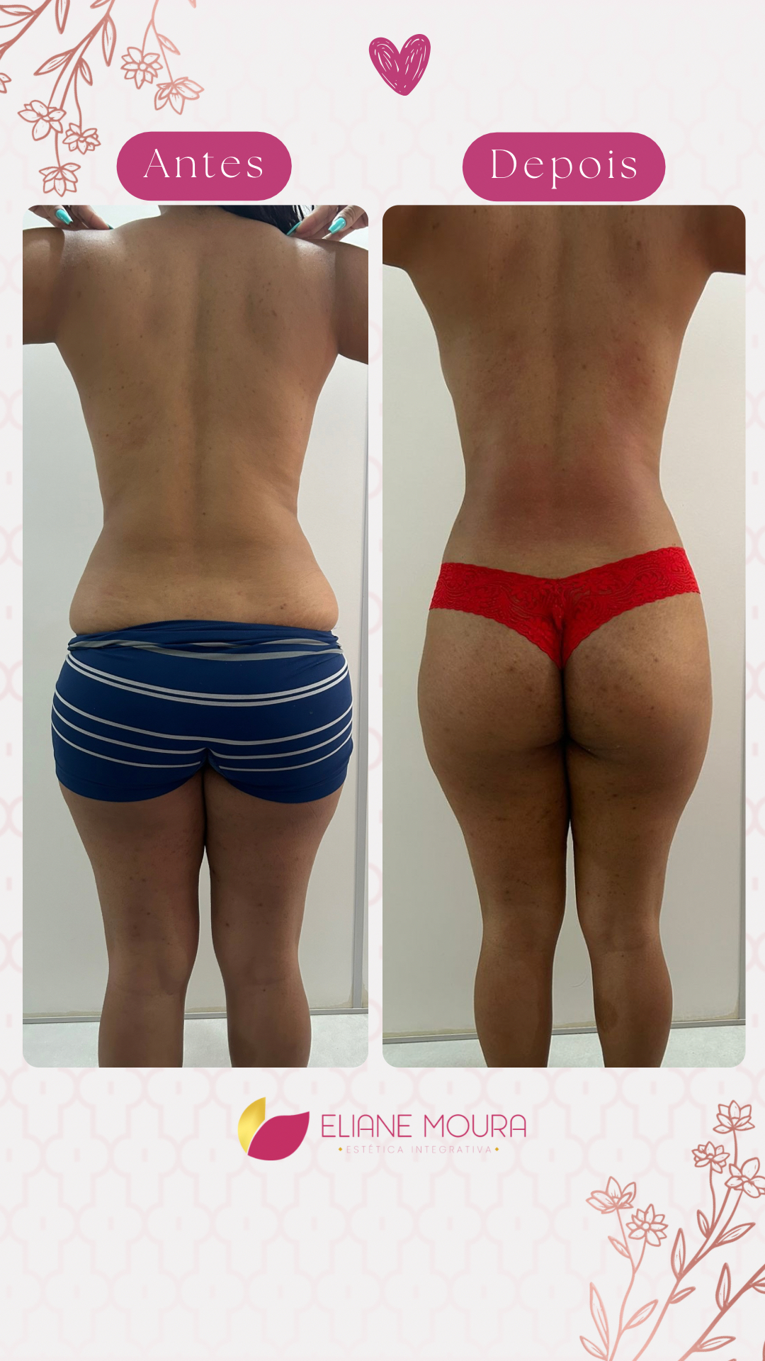 Criomodelagem vs Criolipólise: Qual a Melhor para Você?