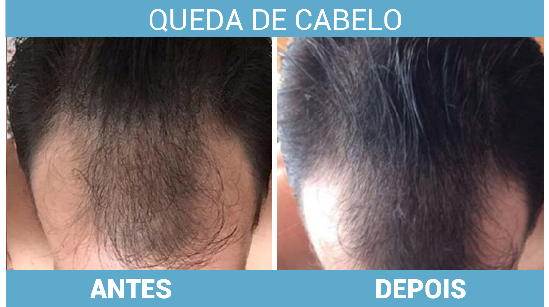 custo tratamento queda de cabelo dermatologista