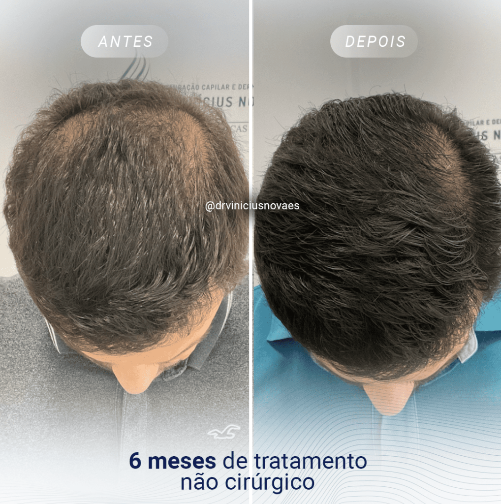 melhores tratamentos queda de cabelo dermatologista