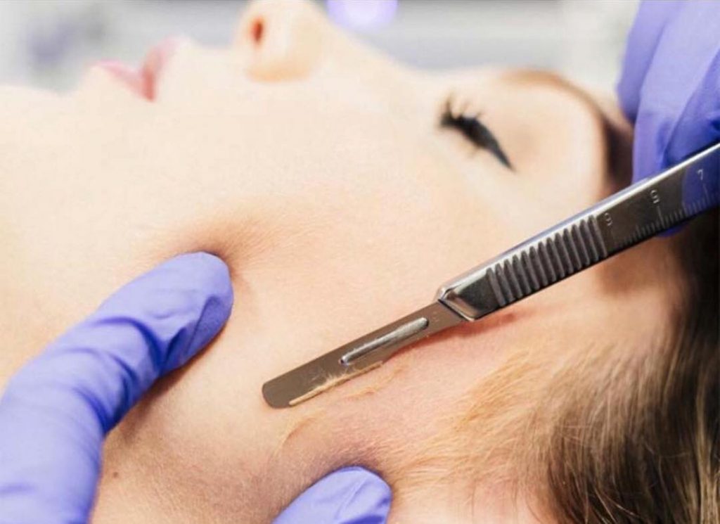 Mitos e Verdades do Dermaplaning: O Que Você Precisa Saber