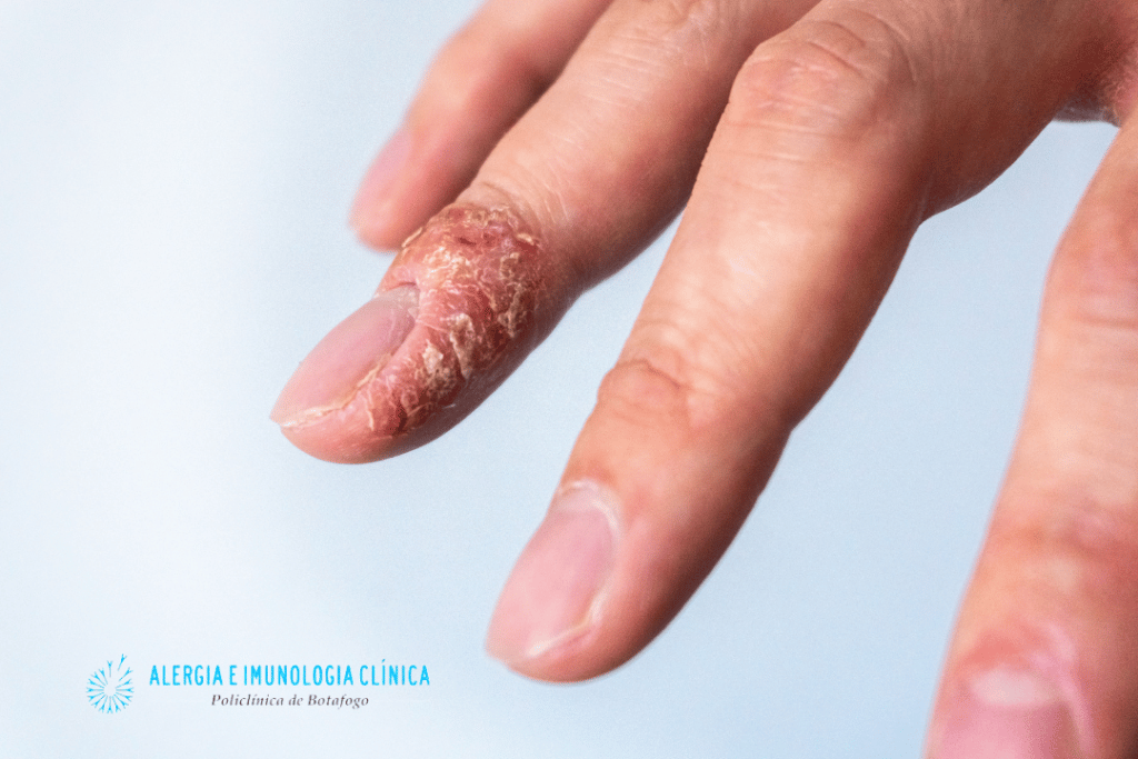 Remédios Caseiros para Aliviar os Sintomas da Dermatite de Contato