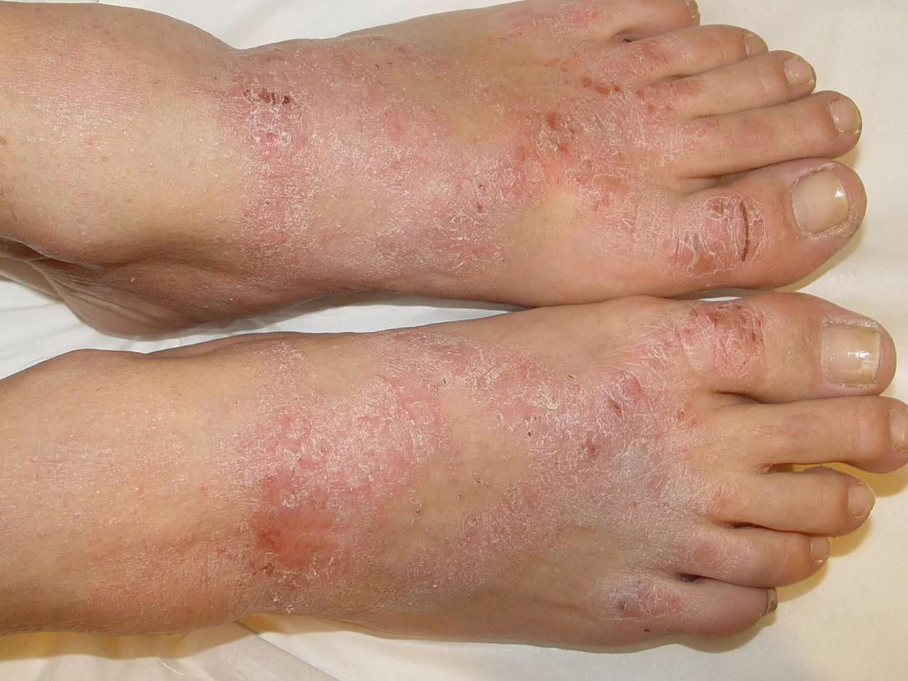 dermatite de contato