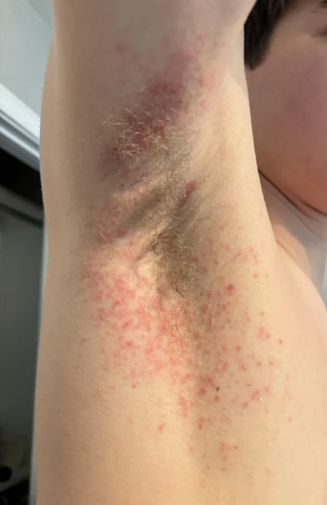 Diferença entre Dermatite de Contato Irritativa e Alérgica