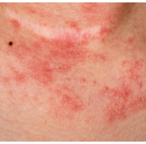 Os 5 Gatilhos Mais Comuns de Dermatite de Contato