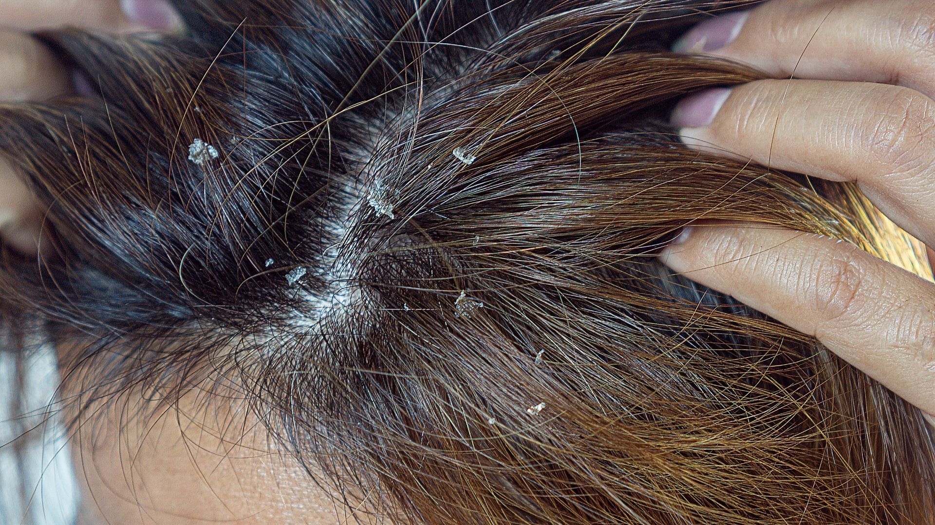 Alimentação e estilo de vida: impacto na dermatite seborreica