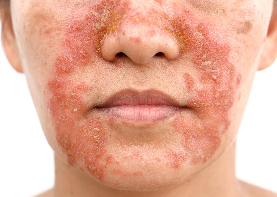 Medicamentos orais para dermatite seborreica grave: quando procurar um dermatologista