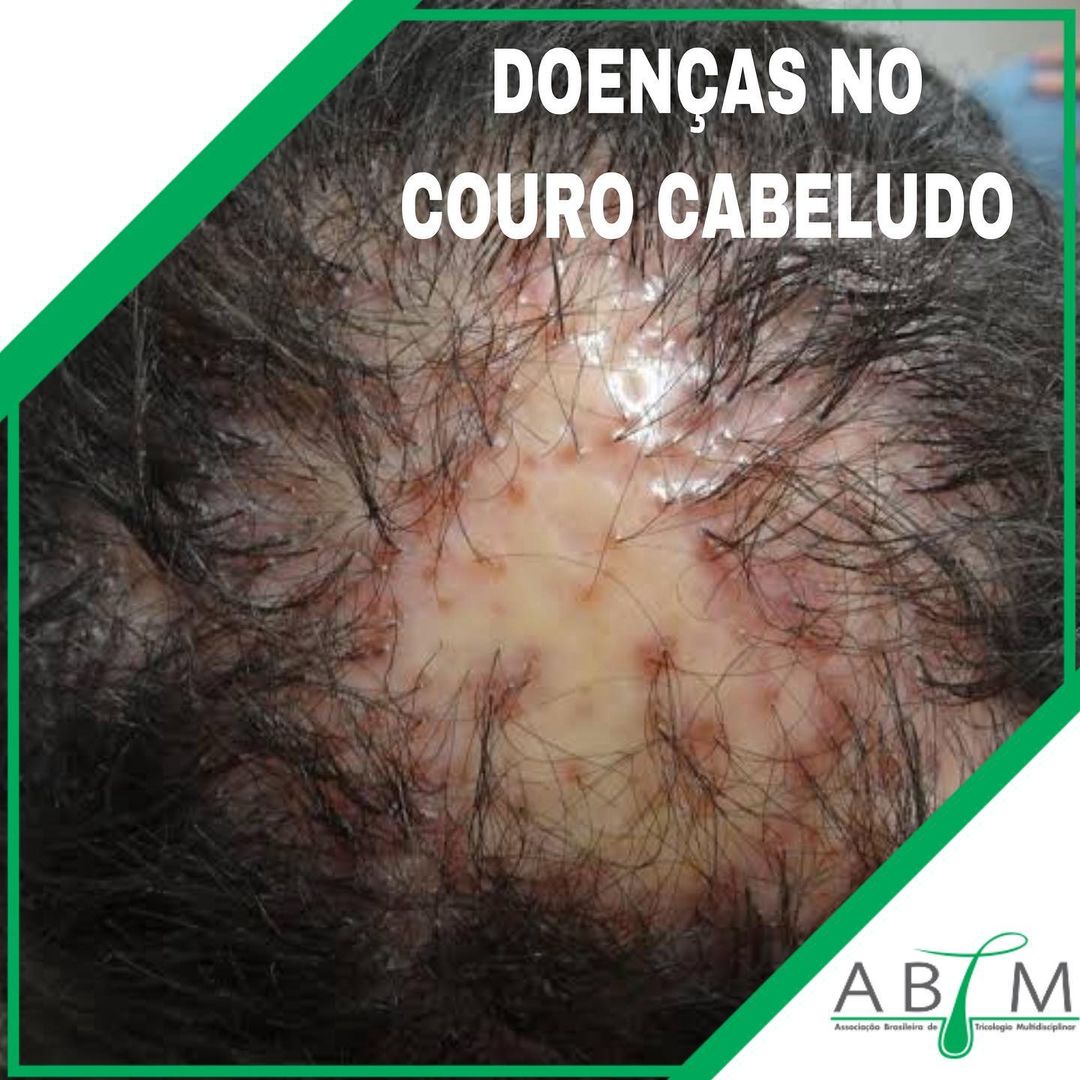 dermatite seborreica tratamento