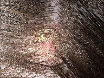 Crosta láctea em bebês: o que é e como tratar com segurança