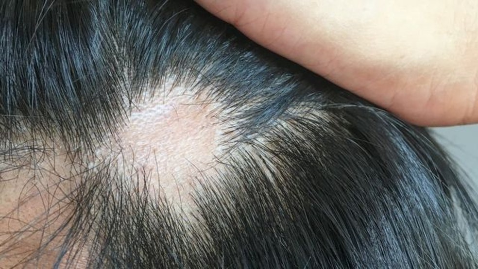 5 ideias de títulos:
1. Tricodinia: Entenda a Dor no Couro Cabeludo e a Queda de Cabelo
2. Causas Comuns de Dor no Couro Cabeludo: De Caspa a Alopecia
3. O Que Fazer Para Aliviar a Dor e a Sensibilidade no Couro Cabeludo?
4. Quando Procurar um Dermatologista para Dor no Couro Cabeludo?
5. Foliculite e Outras Infecções: Como Afetam Seu Couro Cabeludo?