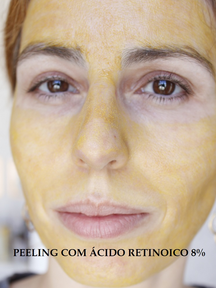 Efeitos Do Peeling De Ácido Retinóico