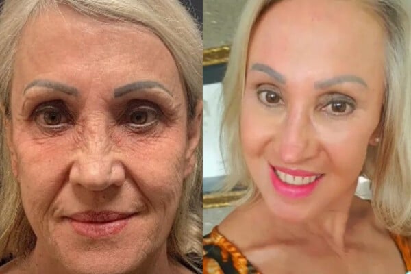 Mitos e Verdades sobre o Pós-Peeling de Ácido Retinóico